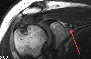 Suprascapular Ganglion Coronal MRI